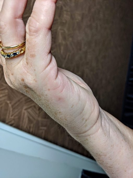 Bed bug bites on Shae's hand at Fairfield Inn & Suites Charlottesville North, VA